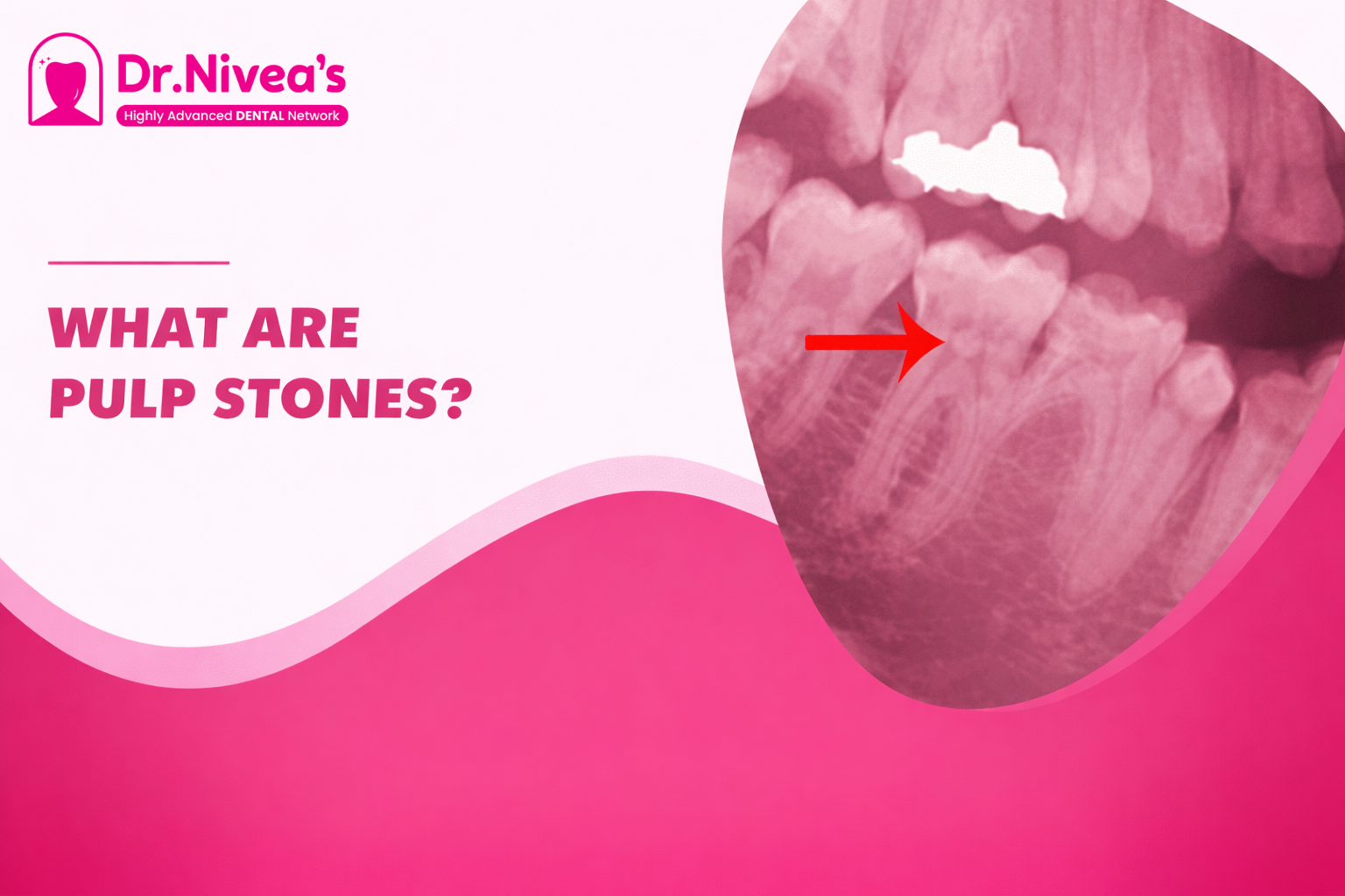 pulp-stones-causes-types-and-treatment-options